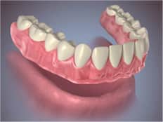 Conventional or Immediate Full Denture