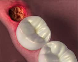 Dry socket after wisdom tooth extraction
