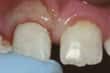 Реимплантация выбитого зуба